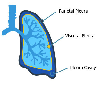 pleural mesothelioma