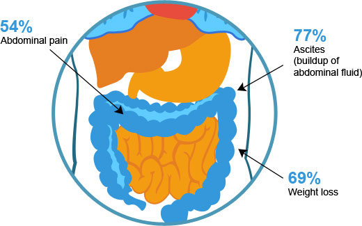 peritoneal mesothelioma