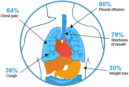 mesothelioma symptoms